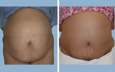 Before and After
